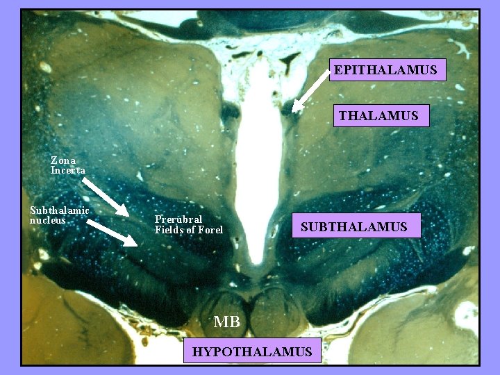 EPITHALAMUS Zona Incerta Subthalamic nucleus Prerubral Fields of Forel SUBTHALAMUS MB HYPOTHALAMUS 