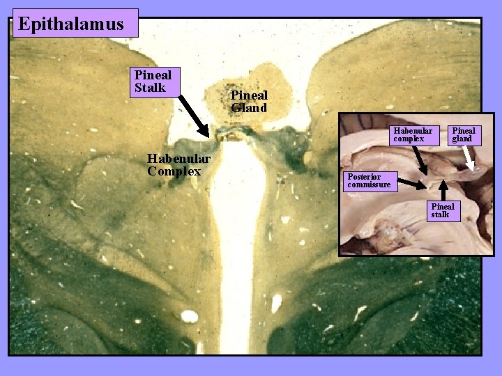 Epithalamus Pineal Stalk Pineal Gland Habenular complex Habenular Complex Pineal gland Posterior commissure Pineal