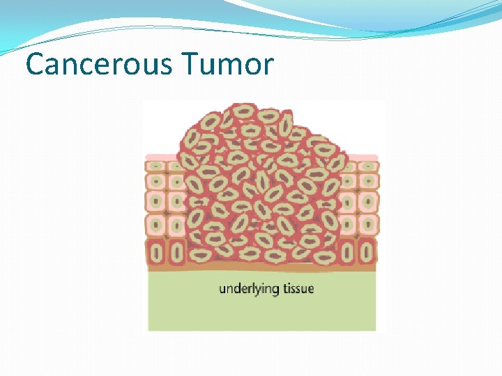 Cancerous Tumor 