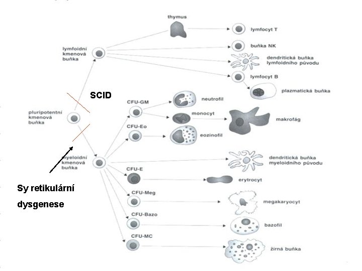SCID Sy retikulární dysgenese 