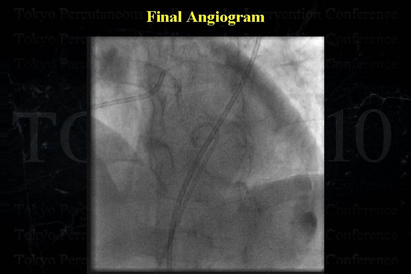 Complication in the Retrograde Approach Masahiko Ochiai MD