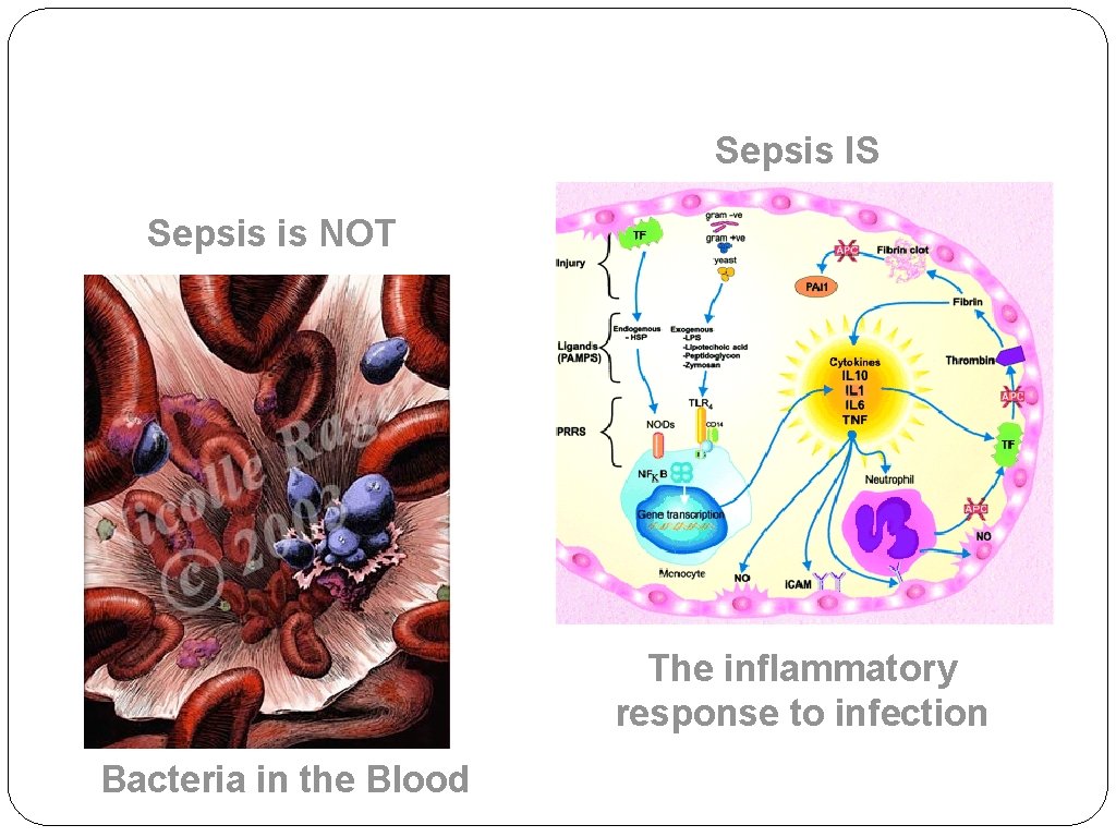 Sepsis IS Sepsis is NOT The inflammatory response to infection Bacteria in the Blood