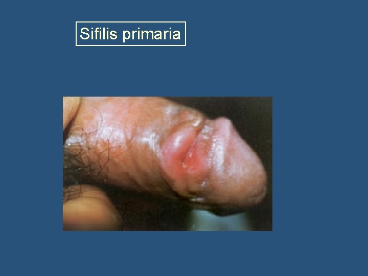 Sifilis primaria 
