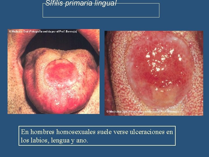 Sífilis primaria lingual En hombres homosexuales suele verse ulceraciones en los labios, lengua y
