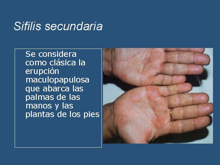 Sifilis secundaria Se considera como clásica la erupción maculopapulosa que abarca las palmas de