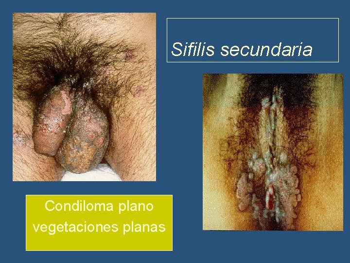 Sifilis secundaria Condiloma plano vegetaciones planas 