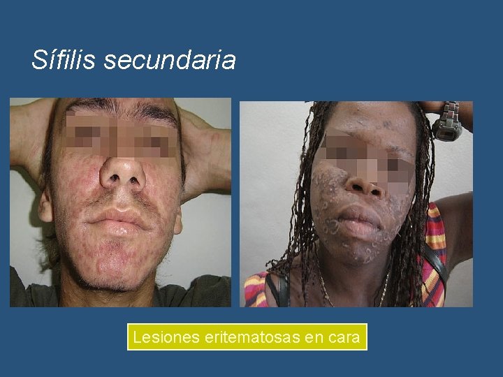 Sífilis secundaria Lesiones eritematosas en cara 