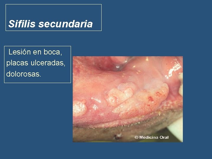 Sifilis secundaria Lesión en boca, placas ulceradas, dolorosas. 