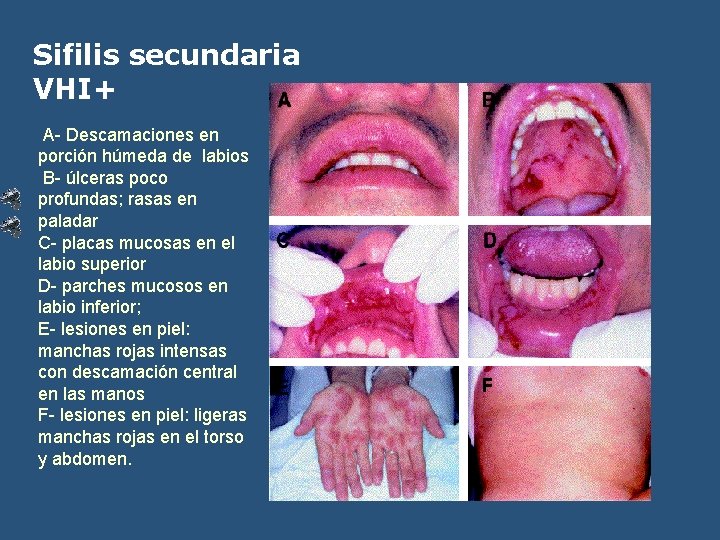 Sifilis secundaria VHI+ A- Descamaciones en porción húmeda de labios B- úlceras poco profundas;
