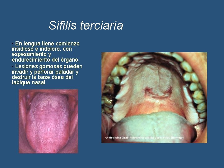 Sifilis terciaria • En lengua tiene comienzo insidioso e indoloro, con espesamiento y endurecimiento