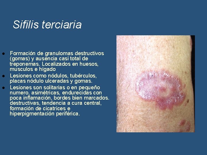 Sifilis terciaria l l l Formación de granulomas destructivos (gomas) y ausencia casi total