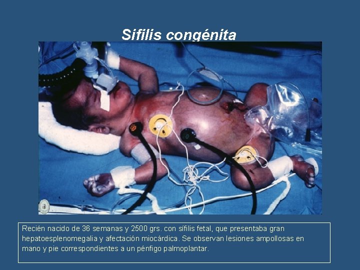 Sifilis congénita Recién nacido de 36 semanas y 2500 grs. con sífilis fetal, que