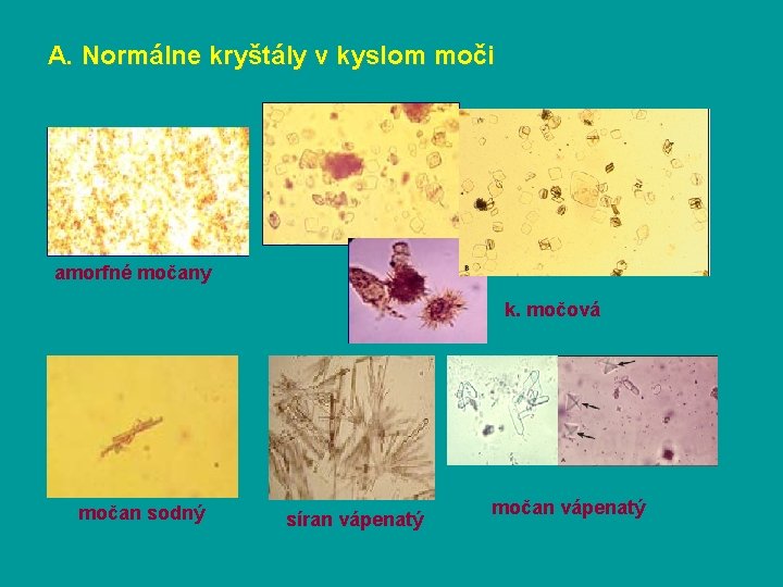 A. Normálne kryštály v kyslom moči amorfné močany k. močová močan sodný síran vápenatý