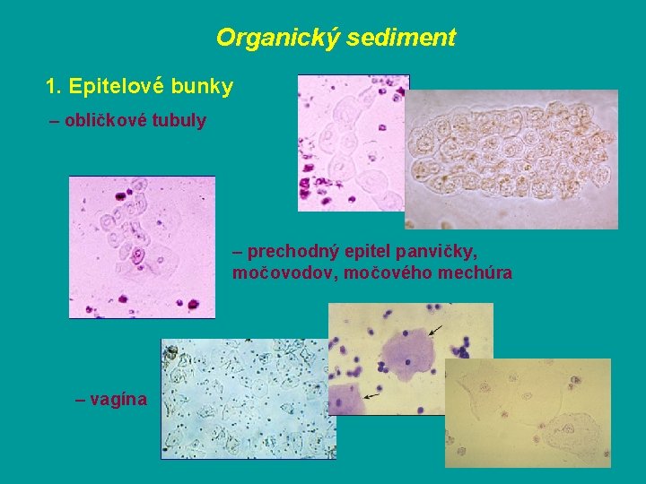 Organický sediment 1. Epitelové bunky – obličkové tubuly – prechodný epitel panvičky, močovodov, močového
