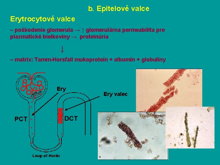 b. Epitelové valce Erytrocytové valce – poškodenie glomerula → ↑ glomerulárna permeabilita pre plazmatické