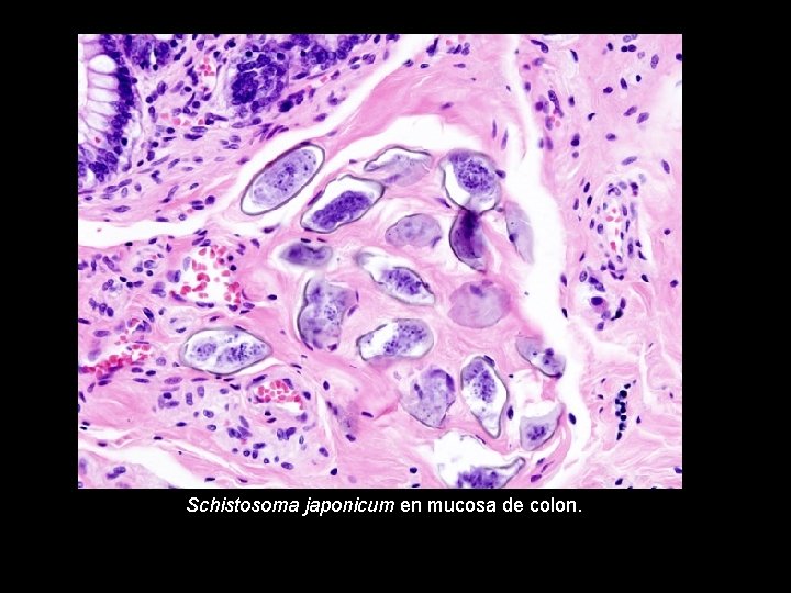 Schistosoma japonicum en mucosa de colon. 