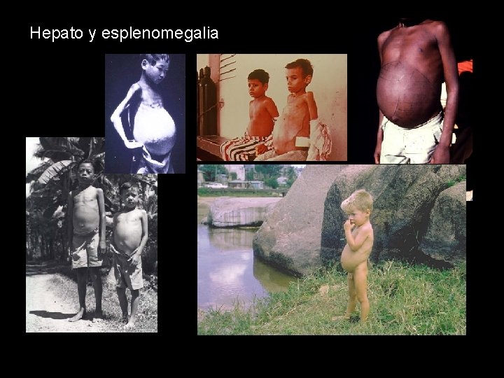 Hepato y esplenomegalia 