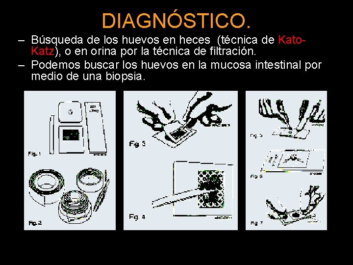 DIAGNÓSTICO. – Búsqueda de los huevos en heces (técnica de Kato. Katz), o en