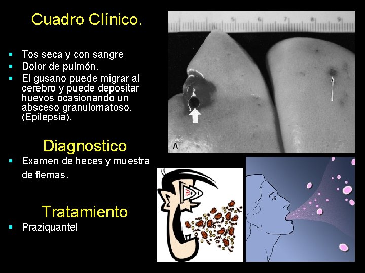 Cuadro Clínico. § Tos seca y con sangre § Dolor de pulmón. § El