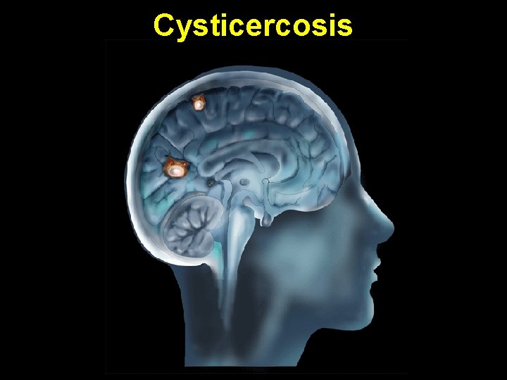 Cysticercosis 