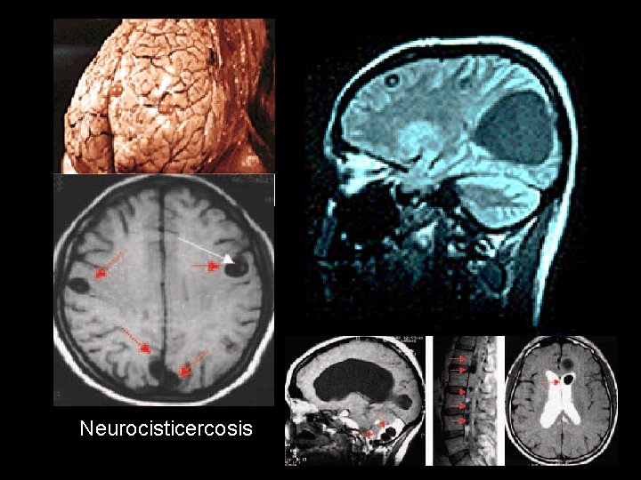 Neurocisticercosis 
