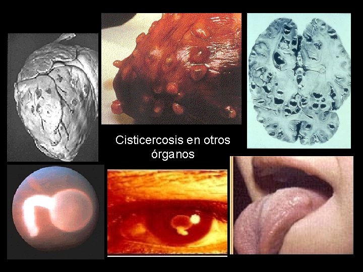 Cisticercosis en otros órganos 
