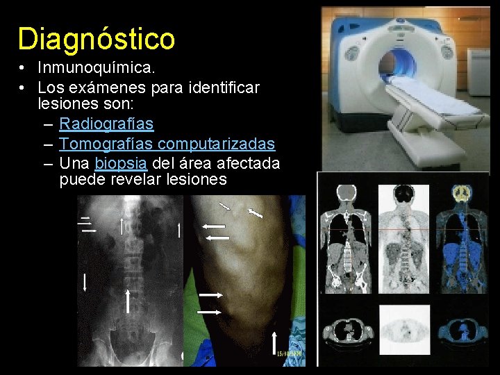 Diagnóstico • Inmunoquímica. • Los exámenes para identificar lesiones son: – Radiografías – Tomografías