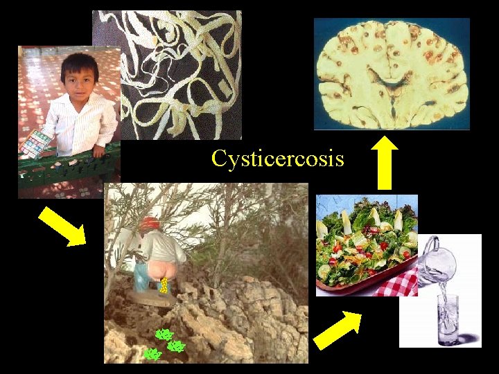 Cysticercosis 