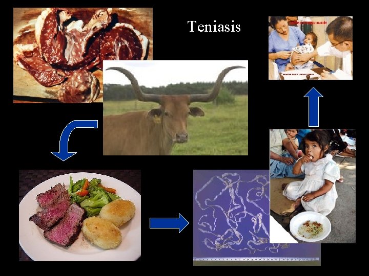 Teniasis 