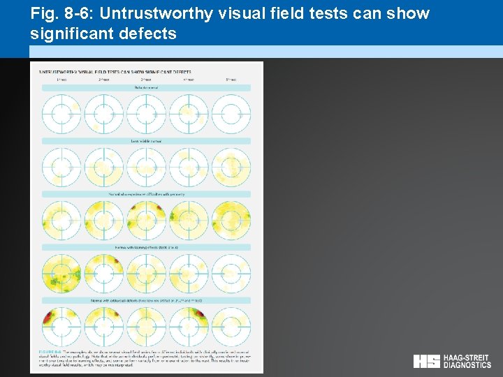 Fig. 8 -6: Untrustworthy visual field tests can show significant defects 