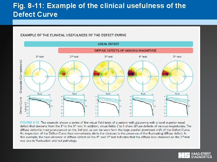 Fig. 8 -11: Example of the clinical usefulness of the Defect Curve 