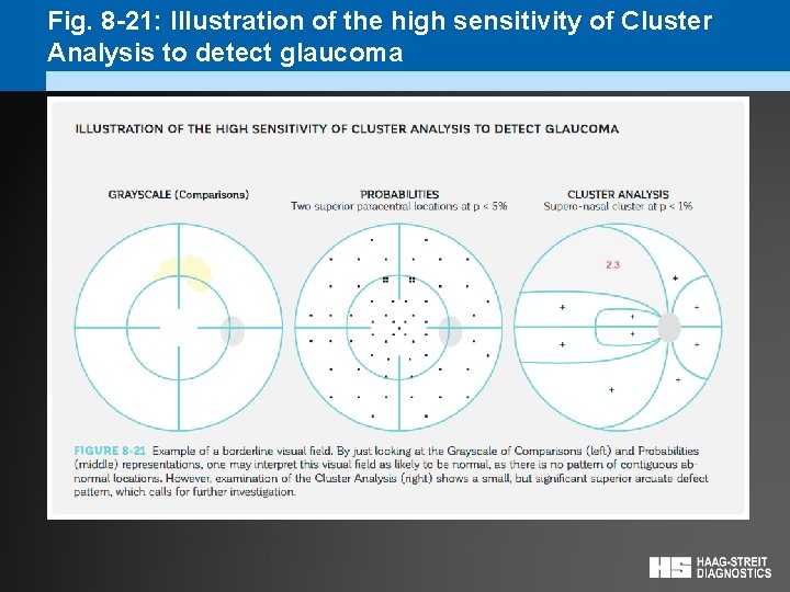 Fig. 8 -21: Illustration of the high sensitivity of Cluster Analysis to detect glaucoma