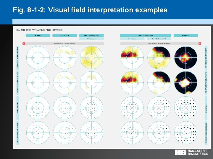 Fig. 8 -1 -2: Visual field interpretation examples 