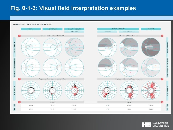 Fig. 8 -1 -3: Visual field interpretation examples 