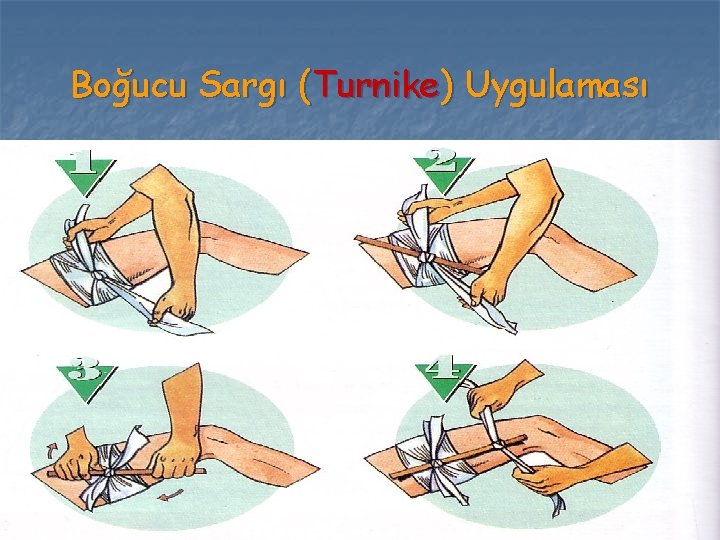 Boğucu Sargı (Turnike) Uygulaması 