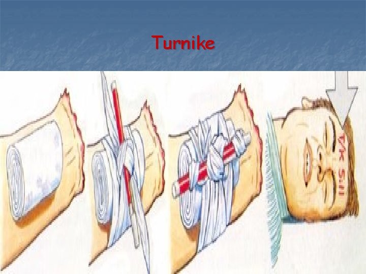 Turnike Turnike