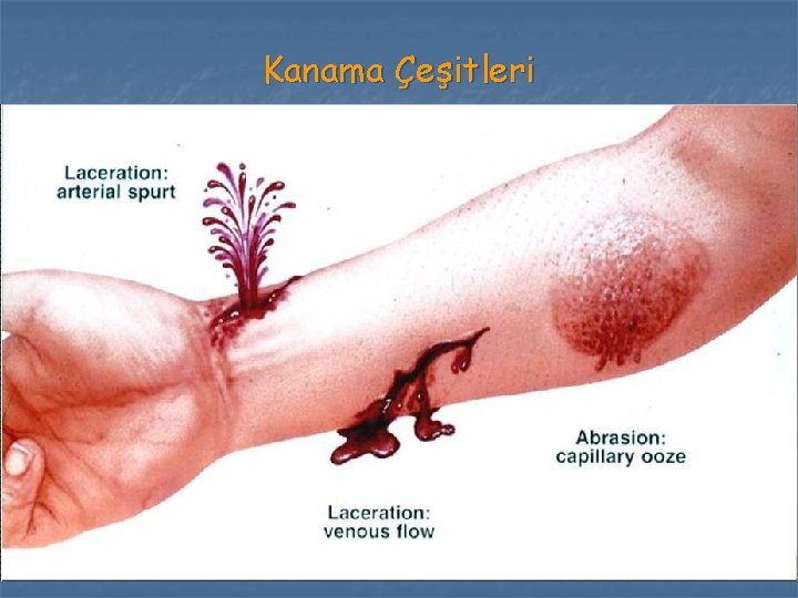 Kanama Çeşitleri Kanama Çeşitleri