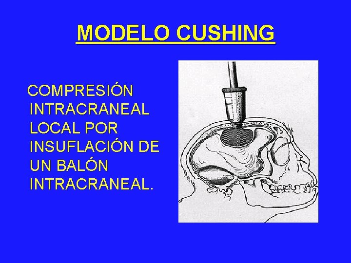 MODELO CUSHING COMPRESIÓN INTRACRANEAL LOCAL POR INSUFLACIÓN DE UN BALÓN INTRACRANEAL. 