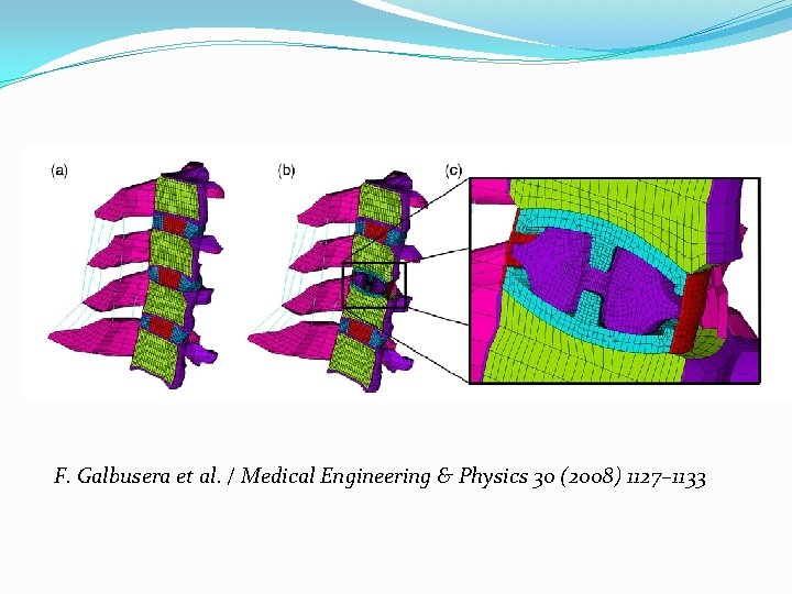 F. Galbusera et al. / Medical Engineering & Physics 30 (2008) 1127– 1133 