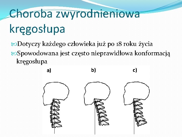 Choroba zwyrodnieniowa kręgosłupa Dotyczy każdego człowieka już po 18 roku życia Spowodowana jest często