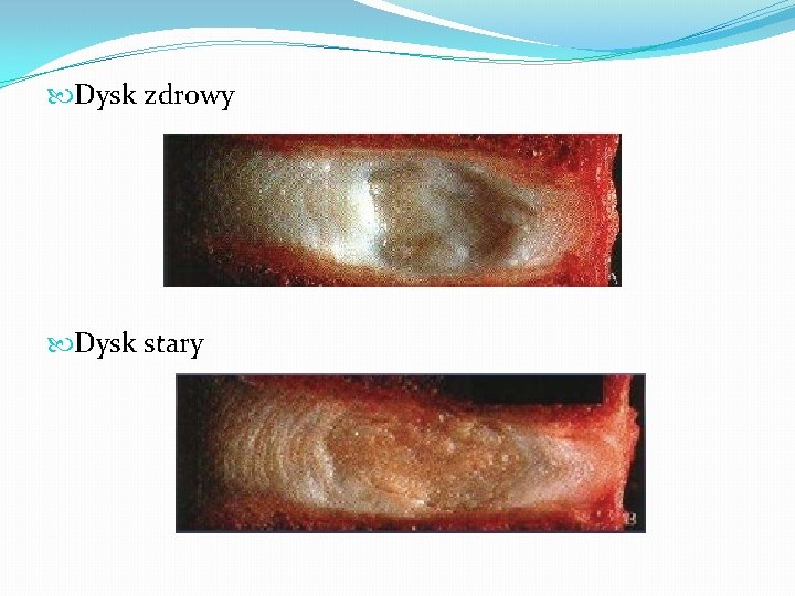  Dysk zdrowy Dysk stary 