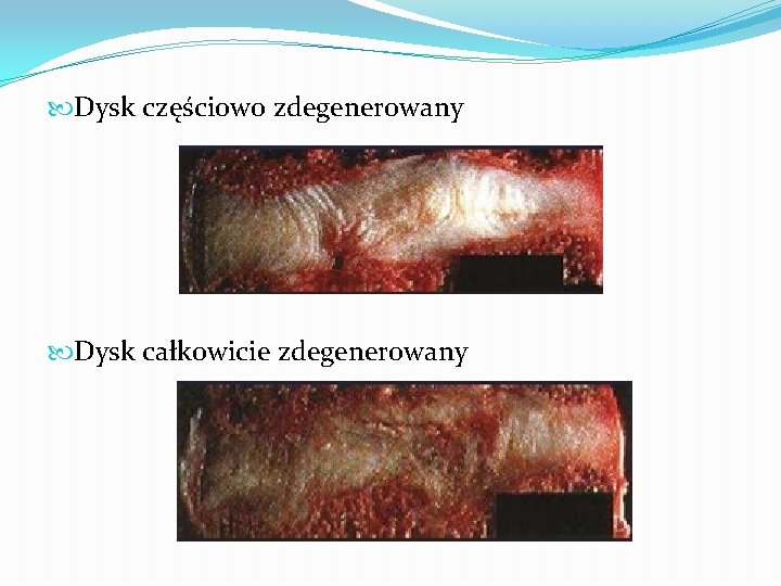  Dysk częściowo zdegenerowany Dysk całkowicie zdegenerowany 