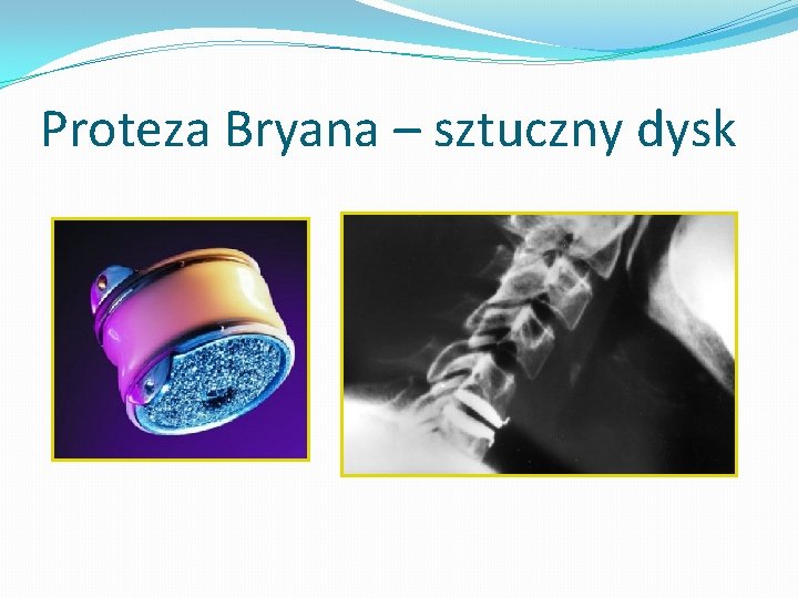Proteza Bryana – sztuczny dysk 