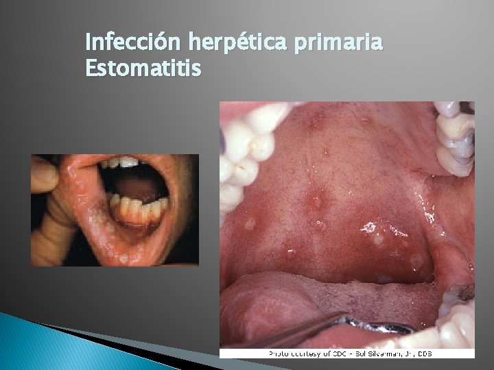 Infección herpética primaria Estomatitis 