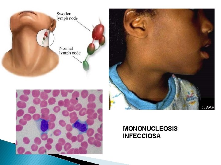 MONONUCLEOSIS INFECCIOSA 