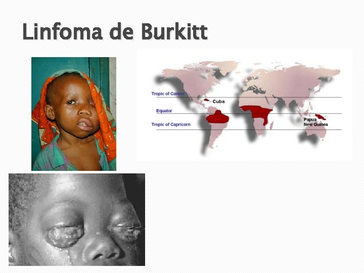 Linfoma de Burkitt 