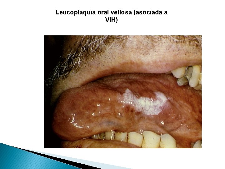 Leucoplaquia oral vellosa (asociada a VIH) 