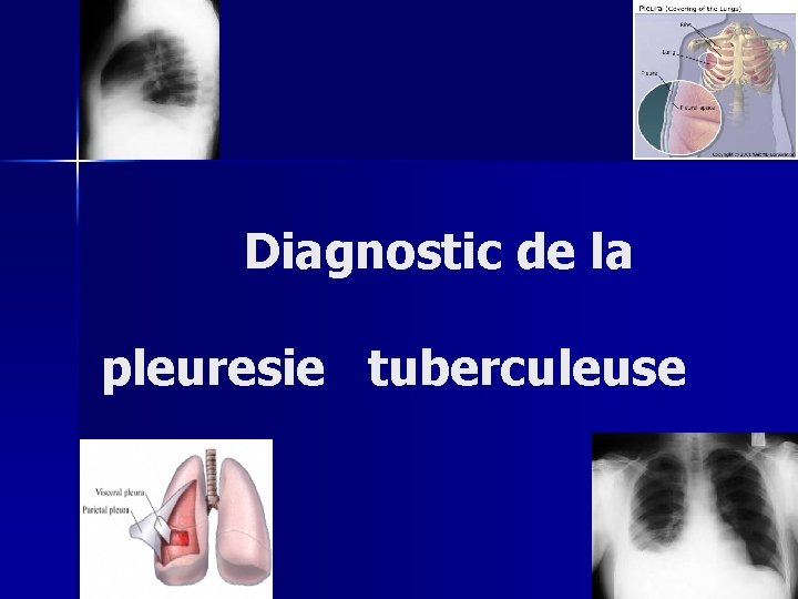 Diagnostic de la pleuresie tuberculeuse 