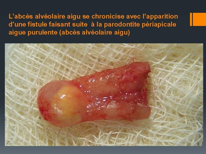 L’abcès alvéolaire aigu se chronicise avec l’apparition d’une fistule faisant suite à la parodontite
