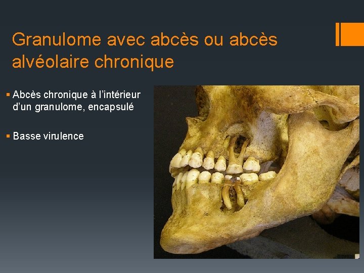 Granulome avec abcès ou abcès alvéolaire chronique § Abcès chronique à l’intérieur d’un granulome,